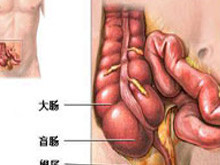 异位阑尾炎