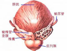 前列腺肉瘤