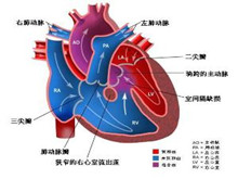 主动脉瓣下狭窄