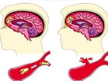 老年脑血栓形成