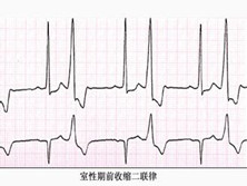 老年期前收缩