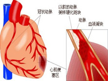 老年甲减性心脏病