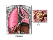 老年急性呼吸窘迫综合征