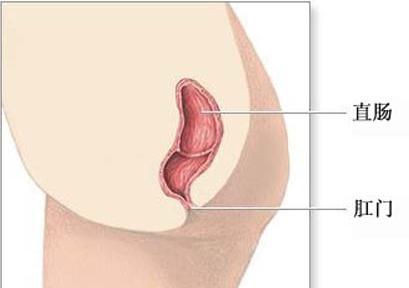 直肠闭锁