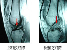前交叉韧带损伤