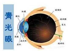 青少年型青光眼