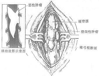 椎管内转移性肿瘤