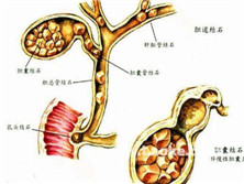 胆管炎性狭窄