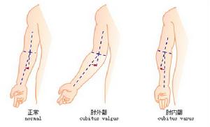肘内翻畸形