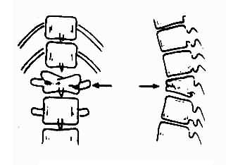 椎体严重楔形变并伴小关节半脱位