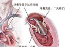 老年心脏传导阻滞