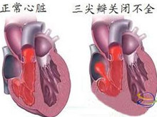 后天性三尖瓣关闭不全