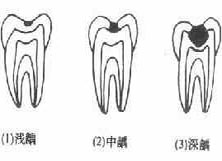 龋病