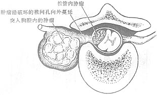 椎管内脊膜瘤