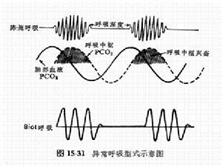 呼吸肌疲劳症