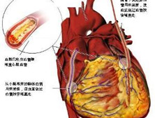 老年无症状性心肌缺血