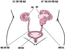 尿路梗阻