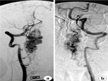 第Ⅱ、Ⅲ型脊髓血管畸形