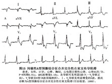 典型预激综合征