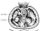 子宫切除术后会阴疝