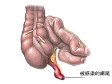 妊娠合并阑尾炎