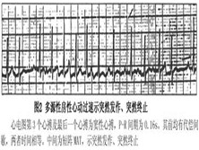 多源性房性心动过速