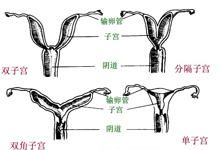 子宫发育异常