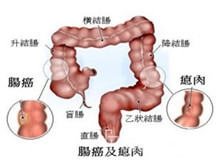 大肠癌