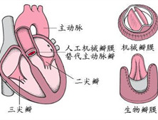 联合瓣膜病变