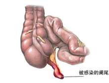 阑尾寄生虫病