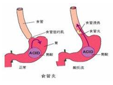 胃型哮喘