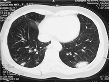 坏死性结节病样肉芽肿病