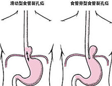 老年食管裂孔疝