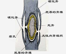 转移性骨肿瘤