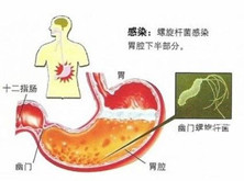 老年胃食管反流病