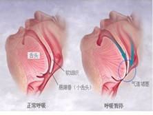 悬雍垂过长