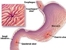 老年消化性溃疡