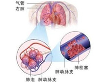 妊娠合并肺栓塞