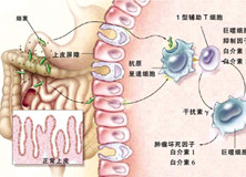 老年炎症性肠病