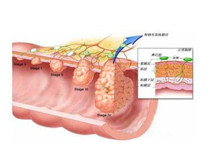 多发性消化道息肉综合征