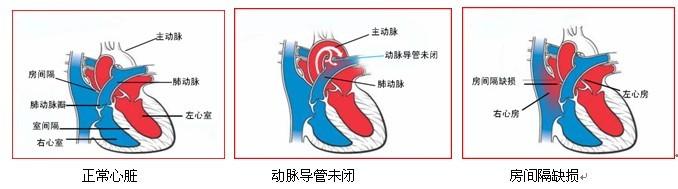 肺静脉异位引流