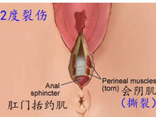 会阴裂伤