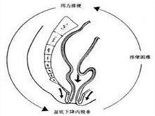 会阴下降综合征