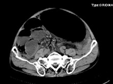 良性阵发性腹膜炎综合征