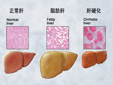 妊娠期急性脂肪肝