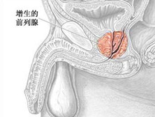 良性前列腺增生