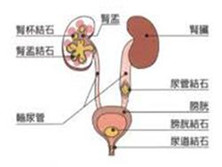 小儿尿石症