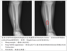 多骨纤维发育不良