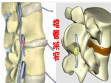 胸椎管狭窄