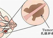 乳房纤维瘤